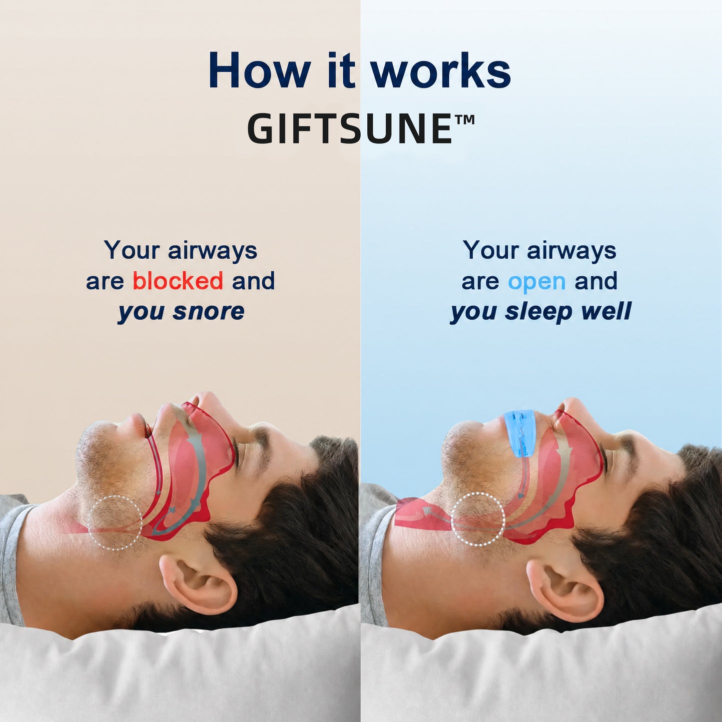 🔥Giftsune™  Professional intelligent anti-snoring device
